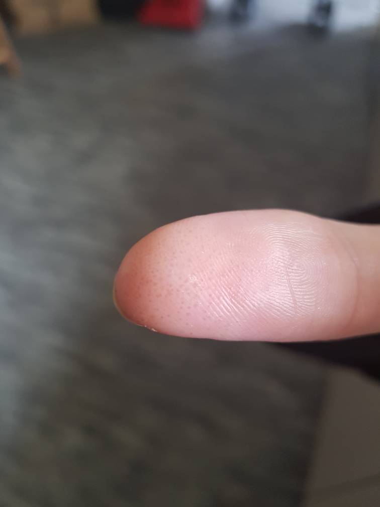 Contact Dermatitis Gel Polish Contact Dermatitis Gel Polish