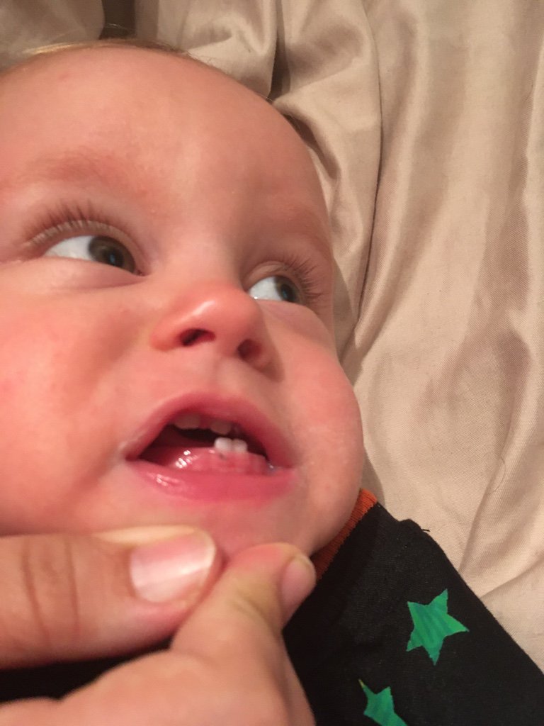 Baby Teething Black And Blue Gums TeethWalls