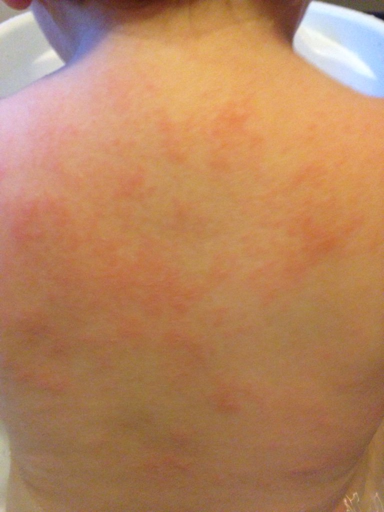 Eczema And Allergy To Soy at Katie Sanchez blog