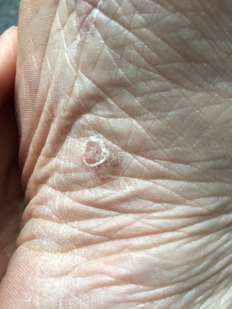 Blisters on feet/lumps