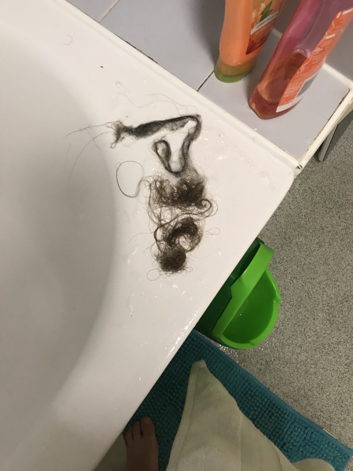 Hair loss nearly 12 moths post delivery!