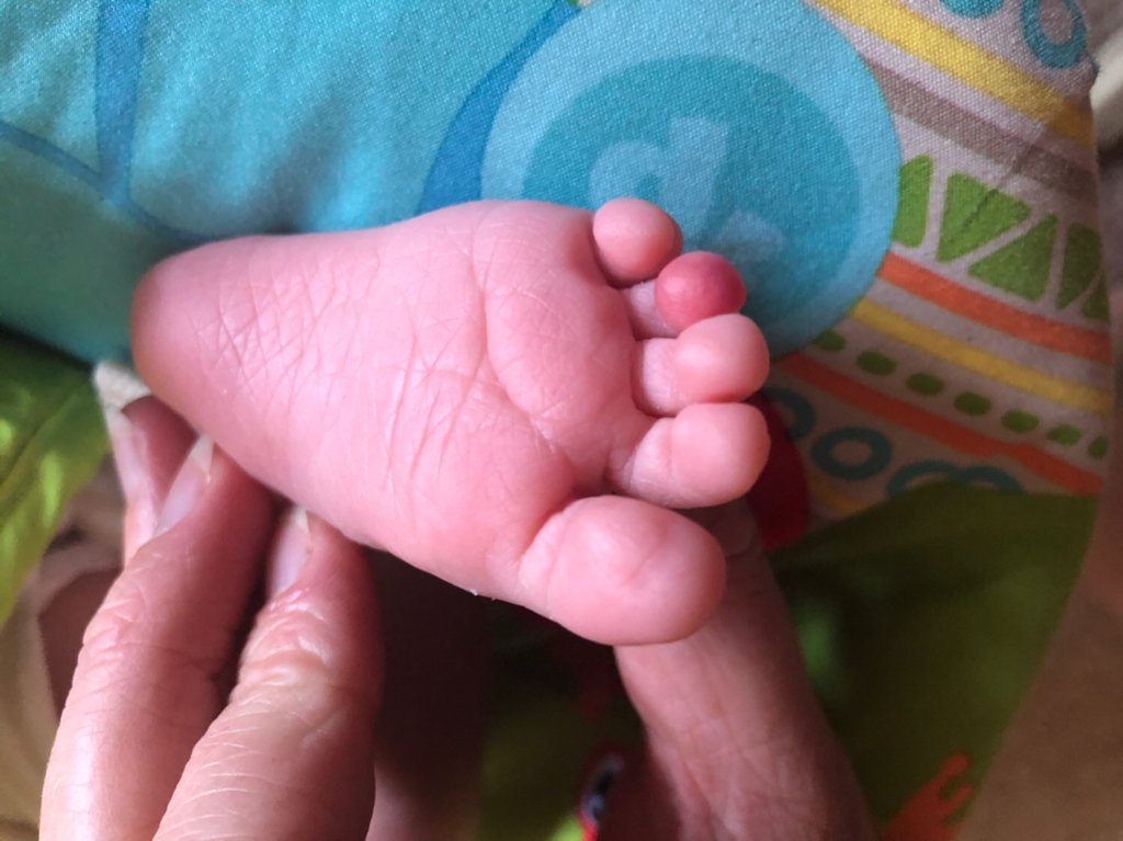 Baby Has A Red Toe Netmums