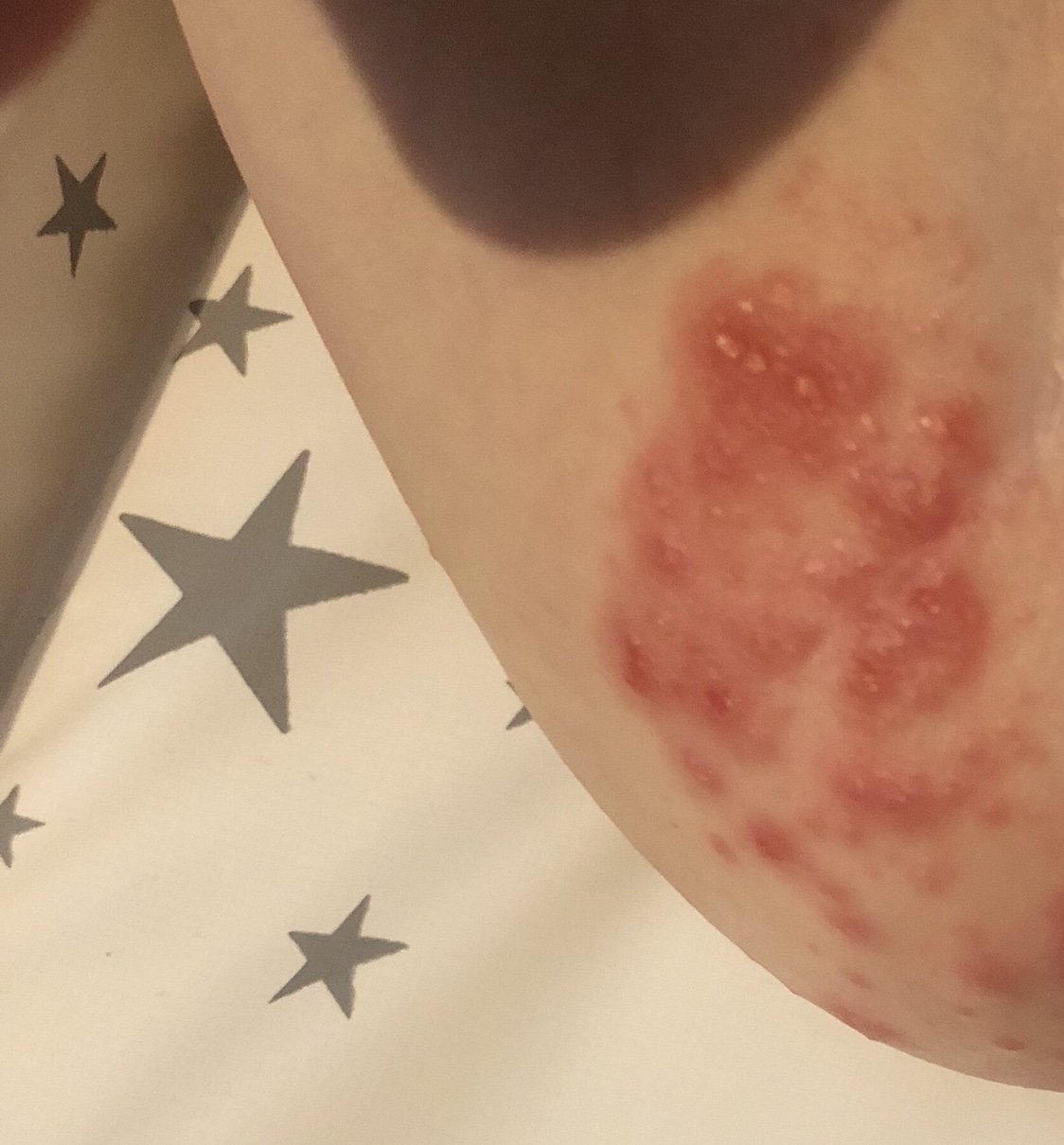 thrush rash