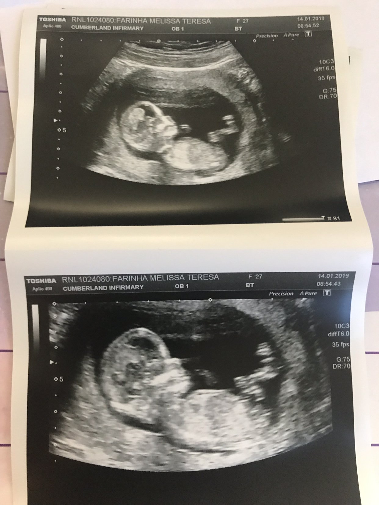 Nub Theory 12 Week Scan